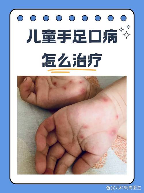 儿童手足口病究竟是好治还是难治？家长该如何应对？-第3张图片-郑州医学网