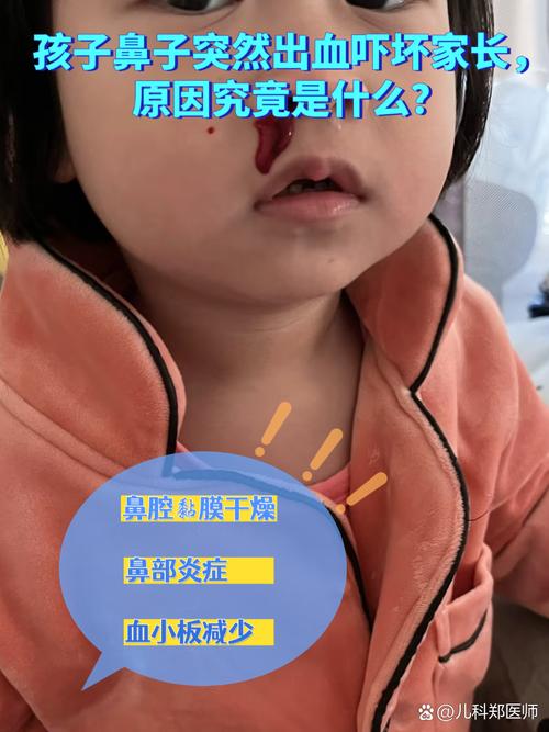 5岁孩子总流鼻血是上火还是生病？家长该怎么处理才正确？-第1张图片-郑州医学网