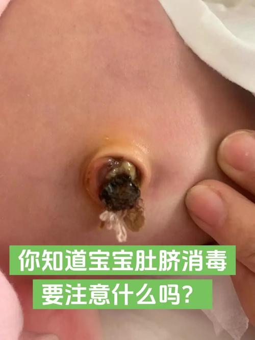 新生儿肚脐眼消毒到底该怎么做才正确？-第3张图片-郑州医学网