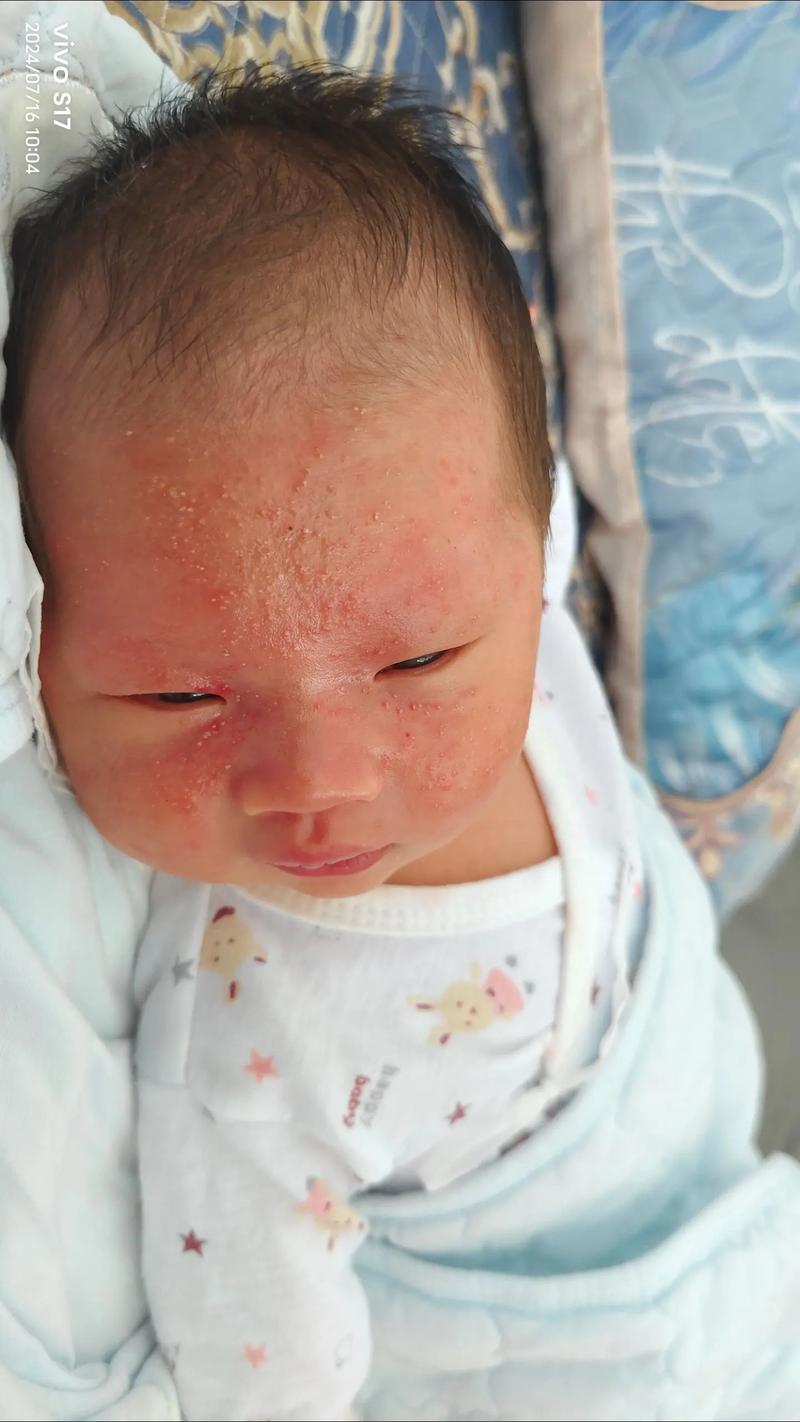 夏天新生儿脸上长痘痘是痱子还是湿疹？该如何正确护理与治疗？-第1张图片-郑州医学网