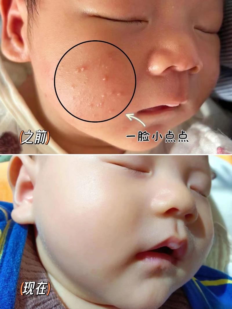 夏天新生儿脸上长痘痘是痱子还是湿疹？该如何正确护理与治疗？-第2张图片-郑州医学网