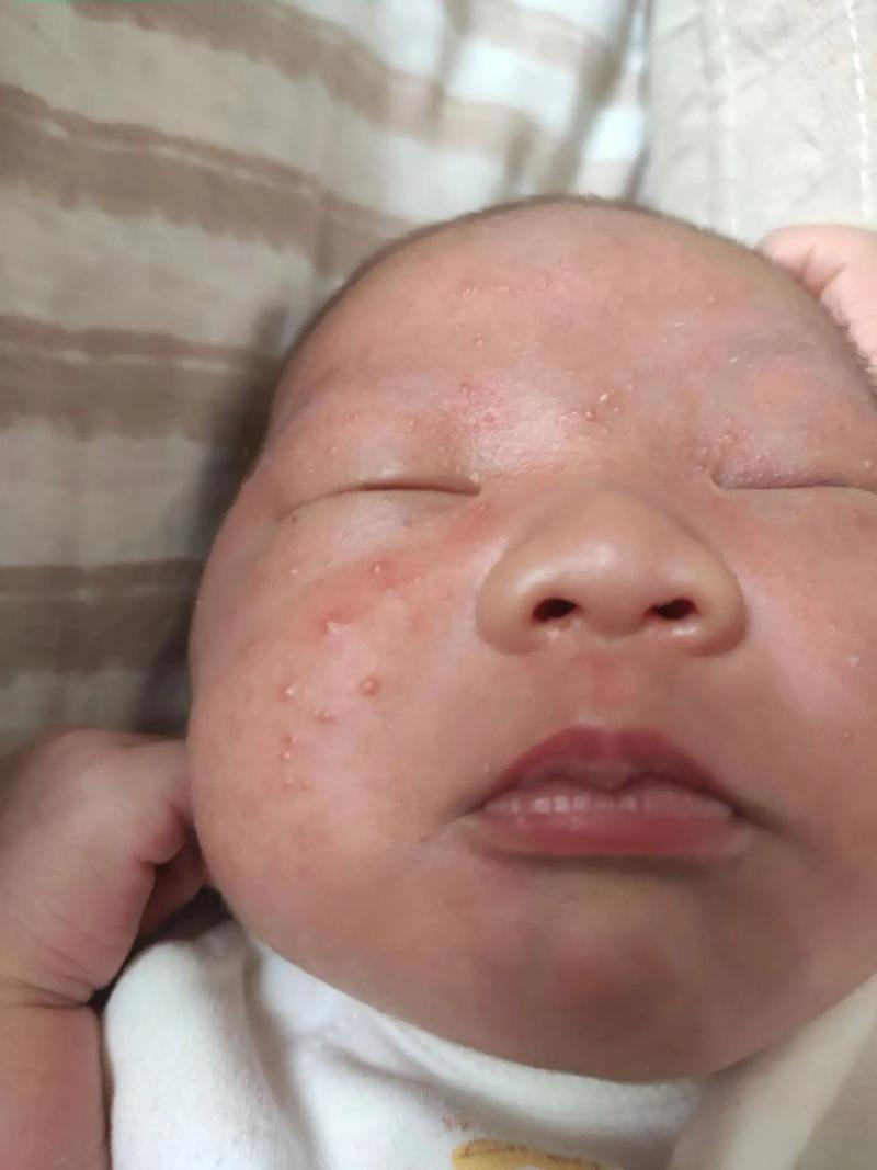 夏天新生儿脸上长痘痘是痱子还是湿疹？该如何正确护理与治疗？-第3张图片-郑州医学网