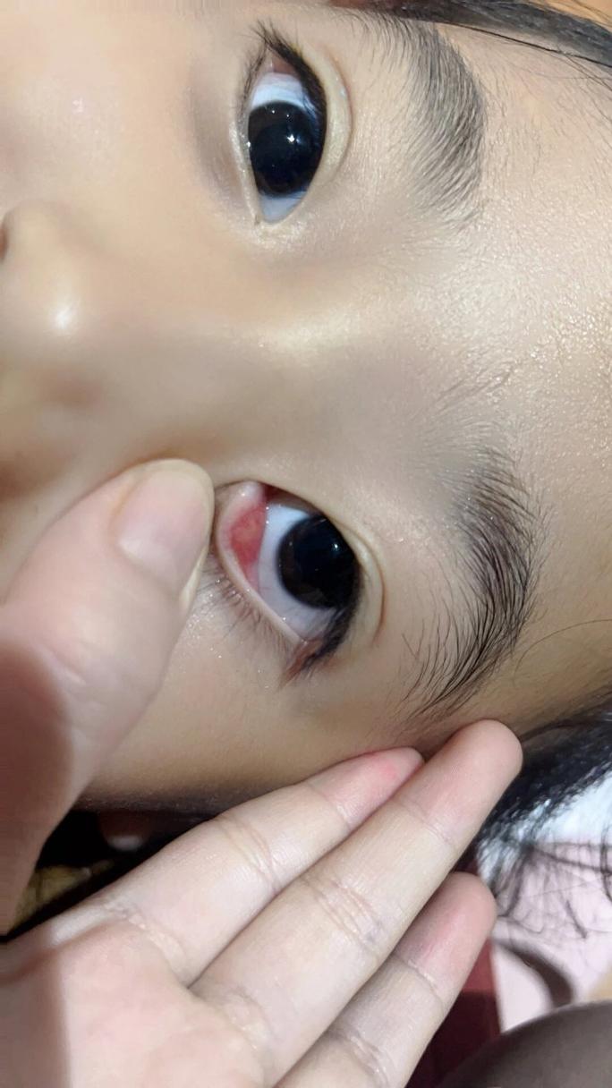 儿童霰粒肿肉芽肿图片是什么样？如何通过图片辨别霰粒肿与肉芽肿的区别？-第2张图片-郑州医学网