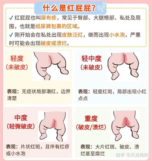 儿童屁股痒是过敏还是寄生虫感染？家长该如何正确处理和预防？-第1张图片-郑州医学网