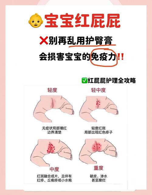 儿童屁股痒是过敏还是寄生虫感染？家长该如何正确处理和预防？-第2张图片-郑州医学网