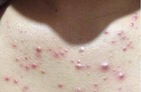 孕期胸前长痘真能预示宝宝性别？男孩女孩和痘痘位置、形态有关联吗？-第1张图片-郑州医学网