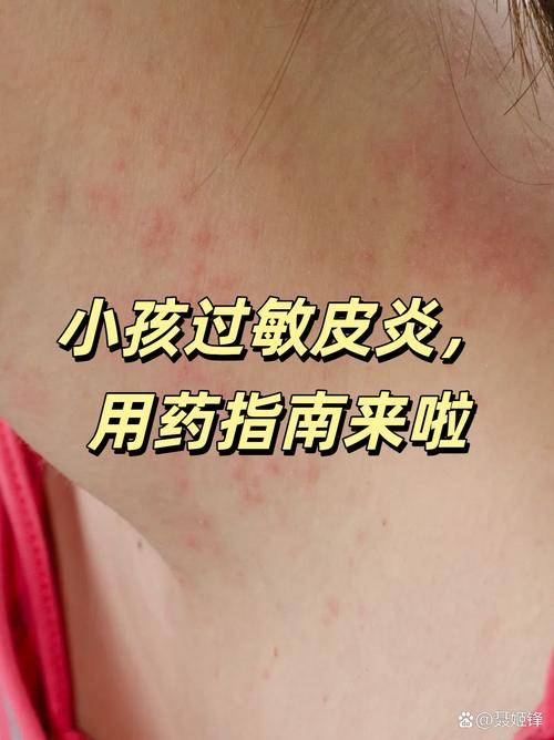 儿童反复过敏反反复复，究竟是哪些潜在因素在作祟？-第3张图片-郑州医学网