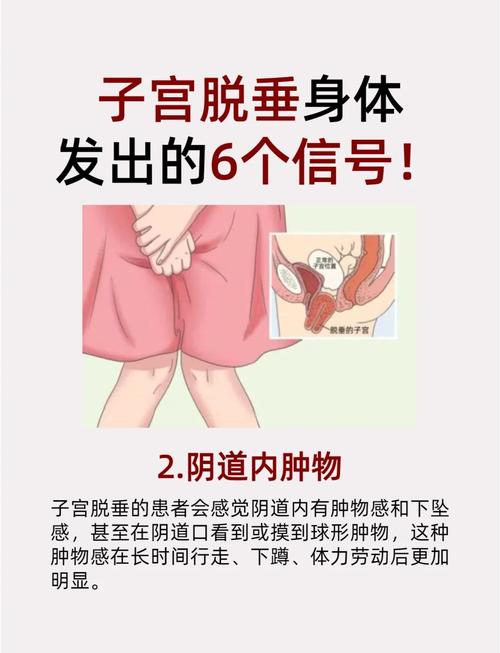 孕期遭遇子宫下垂，产后究竟能否自行恢复？-第1张图片-郑州医学网