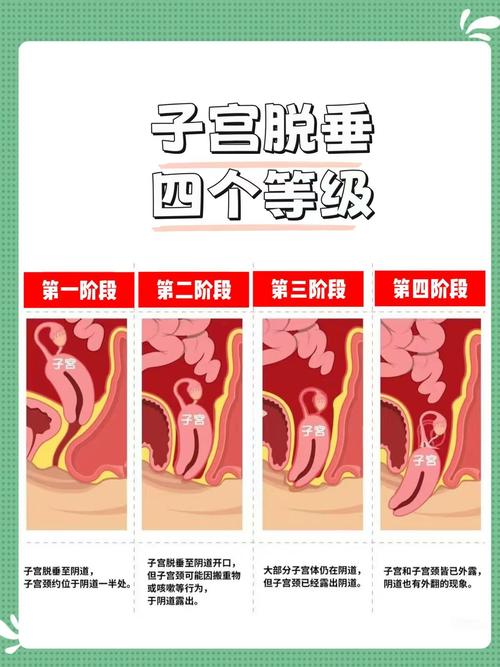 孕期遭遇子宫下垂，产后究竟能否自行恢复？-第2张图片-郑州医学网