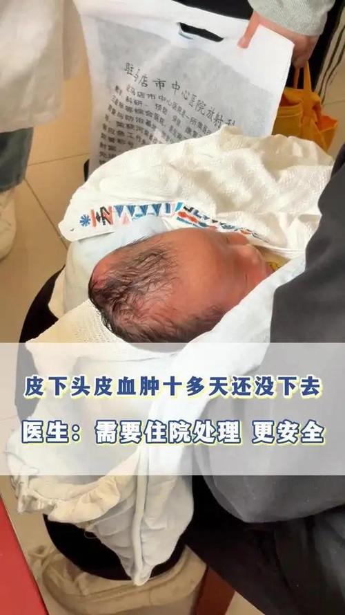 新生儿头皮血肿没满月-第1张图片-郑州医学网
