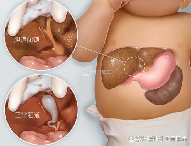 新生儿胆道狭窄会有哪些症状表现？如何早期识别与干预？-第1张图片-郑州医学网