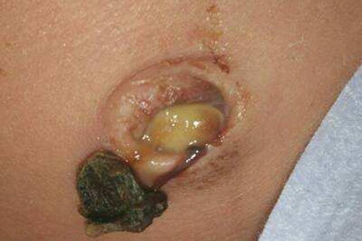 新生儿肚脐化脓了到底有多严重？会不会影响宝宝健康啊？-第1张图片-郑州医学网