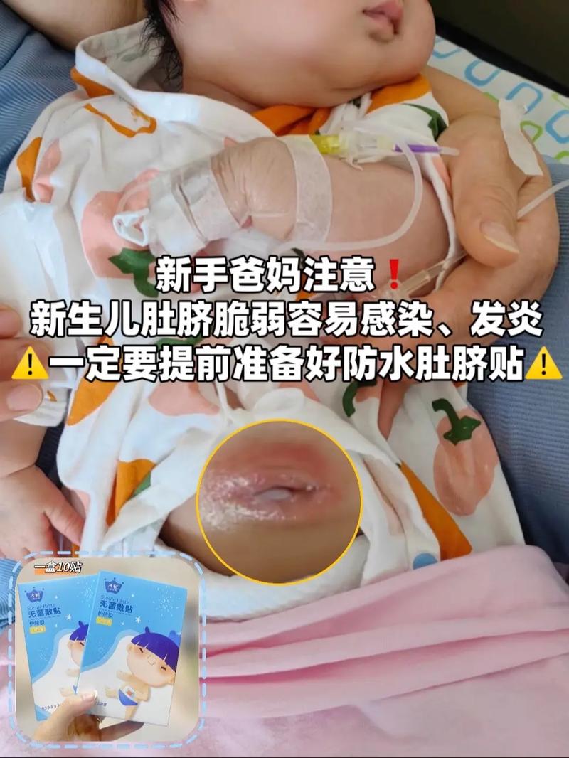 新生儿肚脐化脓了到底有多严重？会不会影响宝宝健康啊？-第2张图片-郑州医学网