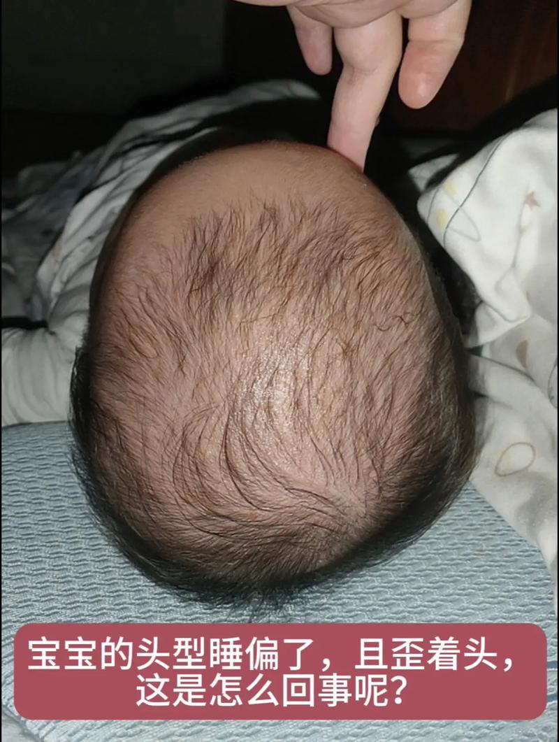 新生儿老是喜欢歪头睡-第2张图片-郑州医学网