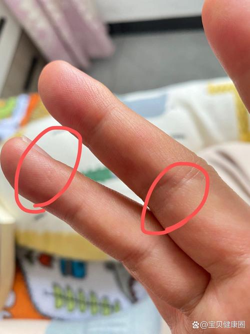 孕期手上起小水泡是湿疹还是疱疹？图片症状如何辨别？-第1张图片-郑州医学网