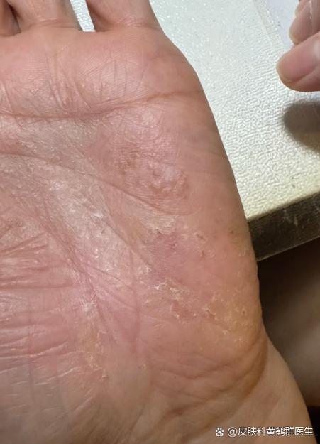 孕期手上起小水泡是湿疹还是疱疹？图片症状如何辨别？-第3张图片-郑州医学网