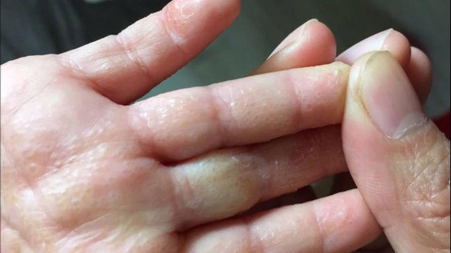 孕期手上起小水泡是湿疹还是疱疹？图片症状如何辨别？-第2张图片-郑州医学网