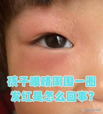 新生儿眼角红斑会自行消退吗？需要干预吗？-第2张图片-郑州医学网